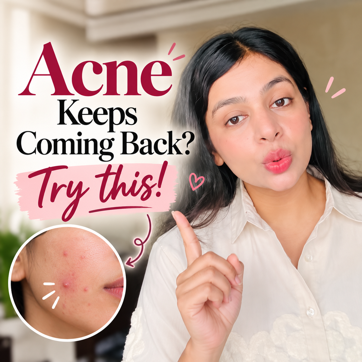 Acne Keeps Coming Back? Donโt Just Dry It Out โ Treat It Smartly