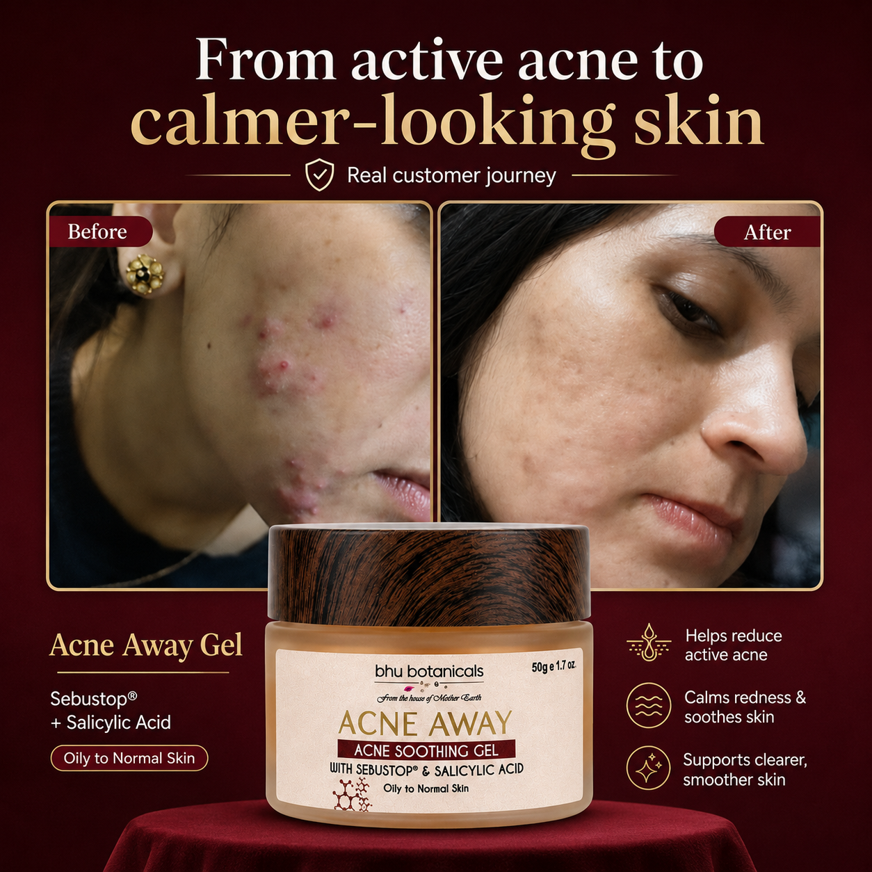 Acne Away - Acne Soothing Gel with Sebustop(R) & Salicylic Acid - 50gm (Oily/Acne Prone Skin)